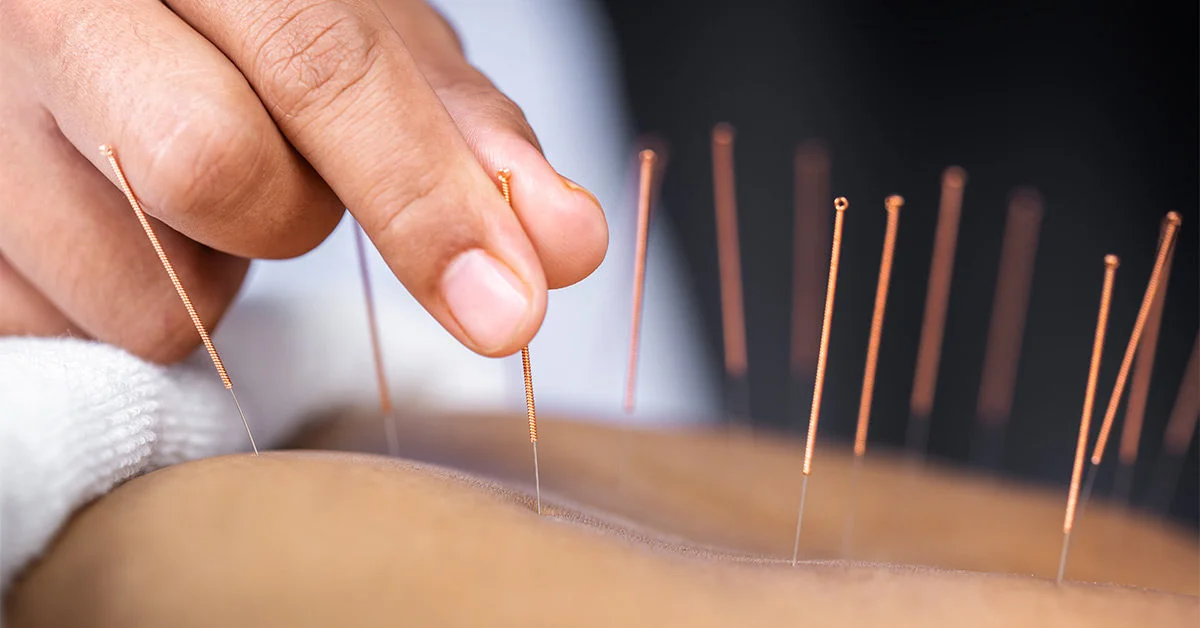 Acupuncture 